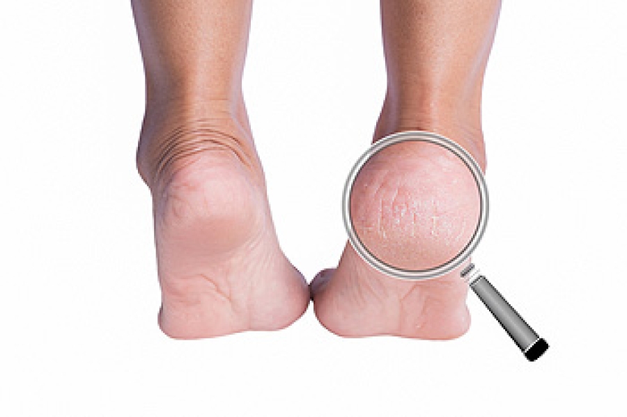 Cracked Heels - Foot & Ankle Centers of Frisco and Plano