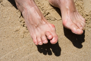 Managing Overlapping Toes at Any Age