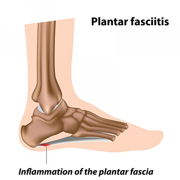 Physical Therapy in our clinic for Heel Pain - Plantar Fasciitis