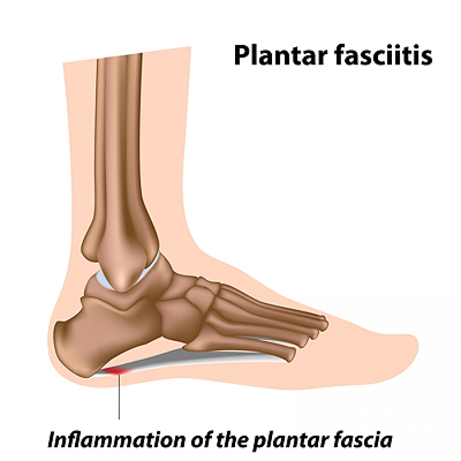 Types of Heel Pain - San Diego