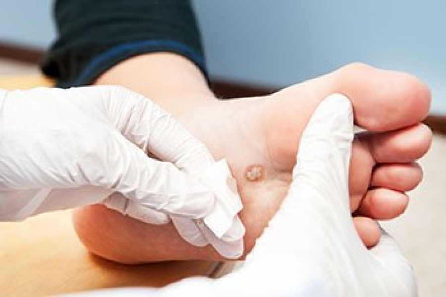 When Should I See a Doctor for Foot Warts?